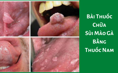 Top 5+ Bài Thuốc Chữa Sùi Mào Gà Bằng Thuốc Nam