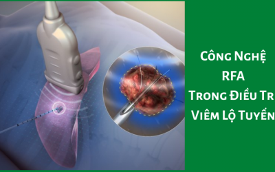 Công Nghệ RFA Trong Điều Trị Viêm Lộ Tuyến