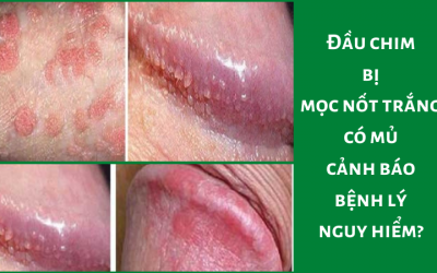 Đầu chim bị mọc nốt trắng có mủ cảnh báo bệnh lý nguy hiểm?