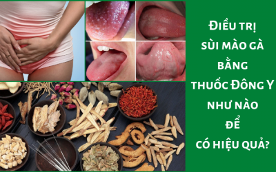 Điều trị sùi mào gà bằng thuốc Đông Y như nào để có hiệu quả?