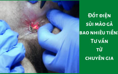 Đốt điện sùi mào gà bao nhiêu tiền? – Tư vấn từ chuyên gia