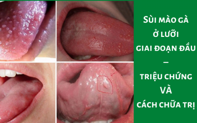 Sùi Mào Gà Ở Lưỡi Giai Đoạn Đầu – Triệu Chứng Và Cách Điều Trị