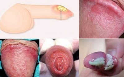 [ CẢNH BÁO ] Viêm bao quy đầu có nguy hiểm không?