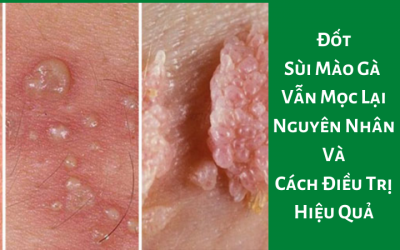 Đốt Sùi Mào Gà Vẫn Mọc Lại – Nguyên Nhân Và Cách Điều Trị Hiệu Quả