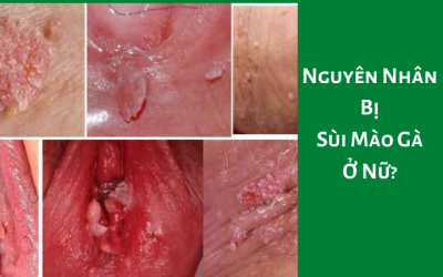 Nguyên Nhân Bị Sùi Mào Gà Ở Nữ? – Bác Sĩ Phụ Khoa Tư Vấn