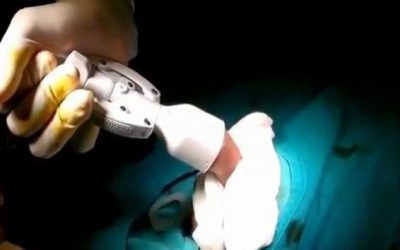 Phẫu thuật cắt bao quy đầu – Tại sao nên cắt và cắt ở đâu Hà Nội?