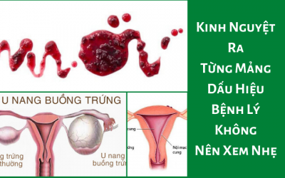 [ Kinh Nguyệt Ra Từng Mảng ] – Dấu Hiệu Bệnh Lý Không Nên Xem Nhẹ