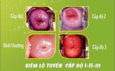 Viêm lộ tuyến cổ tử cung có nguy hiểm không, có chữa được không?