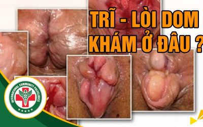 Mừng giáng sinh – Rinh ưu đãi : Gói khám Trĩ – Chỉ 150k với chuyên gia đầu ngành