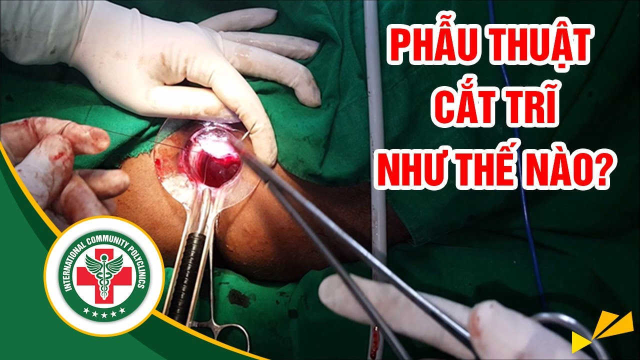 [Video Thực Tế] – Phẫu Thuật Cắt Trĩ Như Thế Nào?