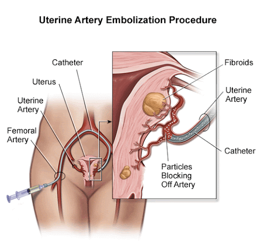 Phương pháp nút mạch u xơ cổ tử cung