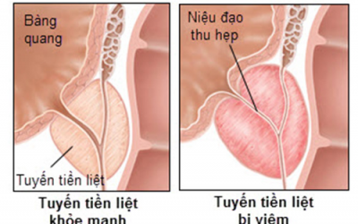 Triệu chứng viêm tuyến tiền liệt ở nam giới?