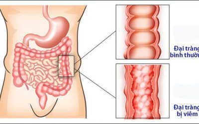 Không Đi Vệ Sinh Được Phải Làm Sao – Mách Bạn 7 Cách