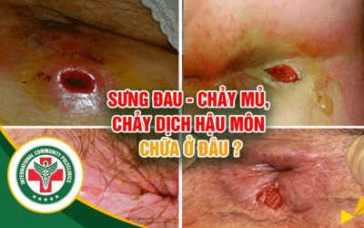 [Rò hậu môn] – Địa chỉ chữa rò hậu môn tốt nhất tại Hà Nội