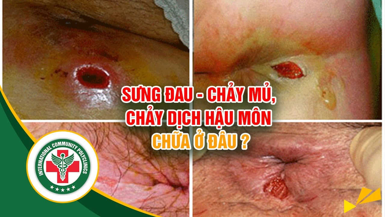 [Rò hậu môn] – Địa chỉ chữa rò hậu môn tốt nhất tại Hà Nội