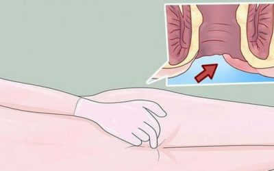 Có Cục Cứng Ở Hậu Môn Là Dấu Hiệu Của Bệnh Gì?