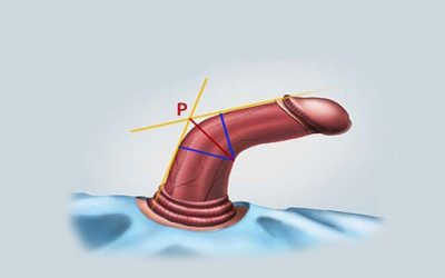 Dương Vật Cong Có Bình Thường Không? – Thông Tin Bạn Cần Biết