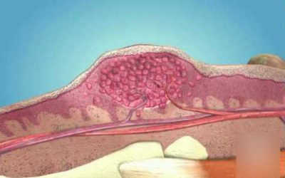 Đốt Sùi Mào Gà Có Để Lại Sẹo Không? Chăm Sóc Sau Khi Đốt