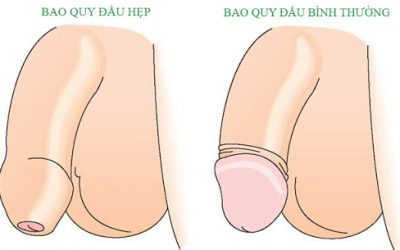 [Giải Đáp] Hẹp Bao Quy Đầu Có Nguy Hiểm Không? Phương Pháp Điều Trị