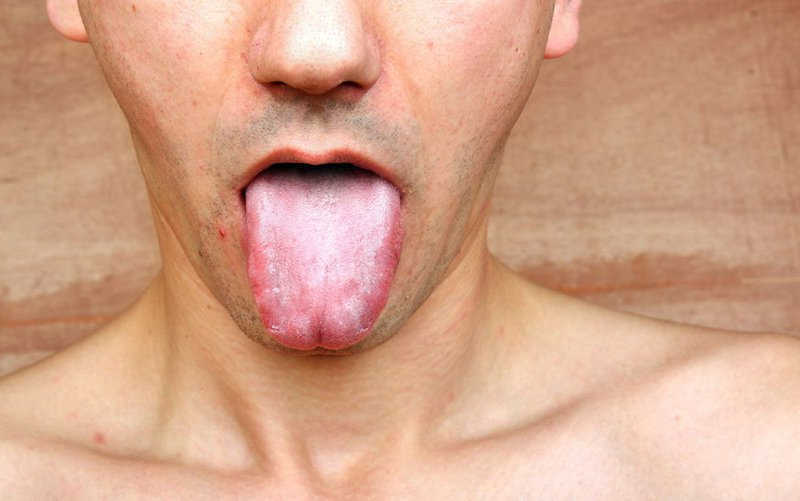 Triệu chứng bệnh giang mai ở lưỡi, miệng