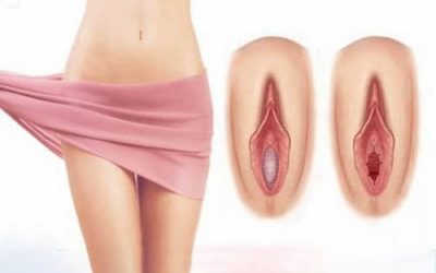 [ Rách âm đạo ] Nguyên nhân, biểu hiện và cách khắc phục