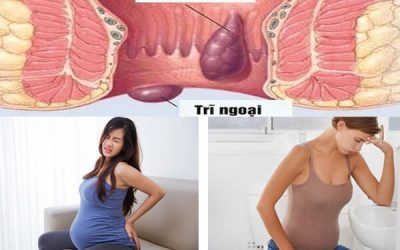 [ BẬT MÍ] 8 Cách chữa bệnh trĩ cho bà bầu đơn giản, an toàn