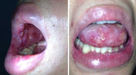 Triệu chứng bệnh lậu ở cổ họng có ảnh hưởng gì không?