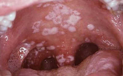 [Danh sách] – Triệu chứng bệnh lậu ở cổ họng cần chú ý