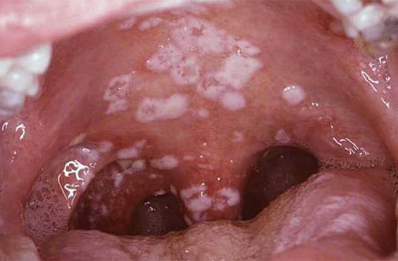 Triệu chứng bệnh lậu ở cổ họng theo từng giai đoạn