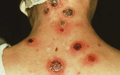 Bệnh giang mai giai đoạn cuối: Biểu hiện và cách điều trị