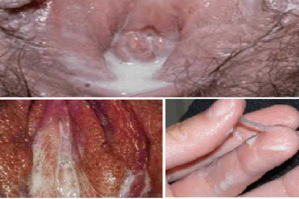 [ BẬT MÍ ] 3+ Cách chữa bệnh lậu ở nữ giới được tổng hợp