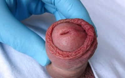 [Giải đáp] Cắt bao quy đầu bao lâu thì tiêu hết chỉ?