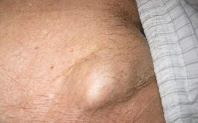 Mọc mụn ở vùng kín nam giới – Nguyên nhân, triệu chứng và cách điều trị