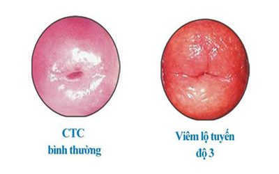 [Hỏi đáp] Cách chữa viêm lộ tuyến độ 3 như nào thì hiệu quả