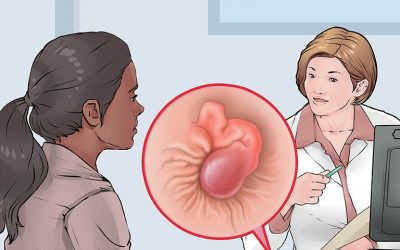 Cách làm co búi trĩ ngoại tại nhà có trị dứt điểm bệnh?