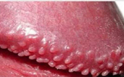 Cách chữa chuỗi hạt ngọc dương vật tại nhà có triệt để?