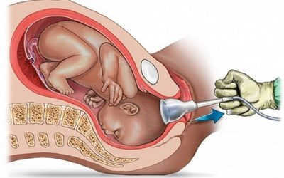 [Bật mí] Sau khi hút thai có được tắm không, gội đầu không?