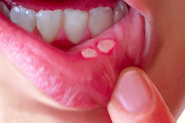 Bệnh nhiễm trùng đường miệng (nhiệt miệng)