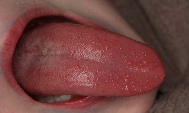 Điều trị cuống lưỡi nổi mụn đỏ như thế nào?