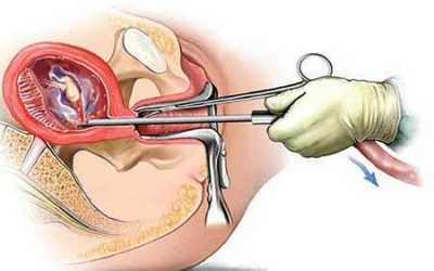 Hút thai an toàn: Thai 4 tuần có hút được không?
