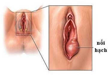 [CẢNH BÁO] Nổi hạch ở bộ phận sinh dục nữ hiểm họa nguy hiểm