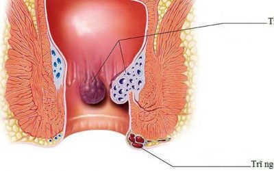 Làm thế nào để phân biệt trĩ nội và trĩ ngoại?