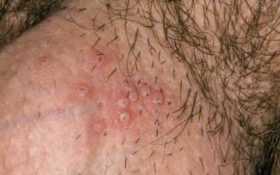 Mụn rộp sinh dục bôi thuốc gì? TOP các loại thuốc hiệu quả nhất