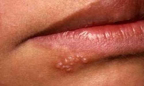 Các giai đoạn của mụn rộp sinh dục ở miệng