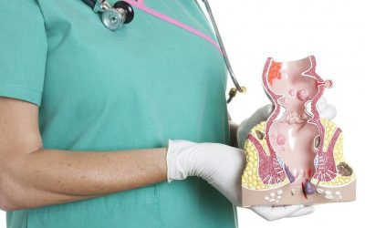 Thực hư bệnh trĩ không bị tái phát sau khi cắt?