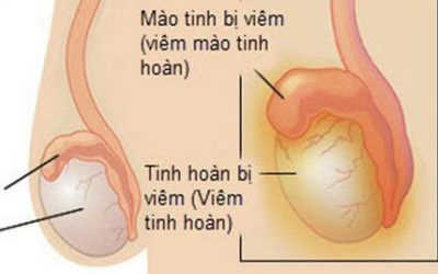 [ LÀM RÕ ] Bệnh viêm tinh hoàn nguyên nhân do đâu?