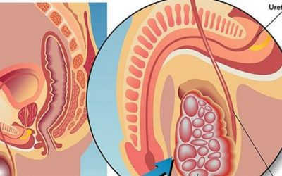 Nguyên nhân tinh hoàn chảy xệ và cách điều trị hiệu quả
