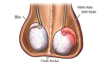 Viêm mào tinh hoàn nên ăn gì, kiêng ăn gì và kiêng làm gì?
