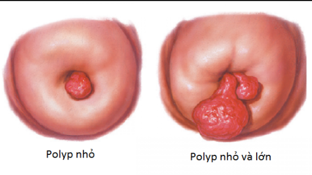 Bệnh polyp cổ tử cung