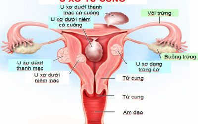 Mổ u xơ tử cung ở đâu tốt nhất? Top 5 địa chỉ uy tín tại Hà Nội